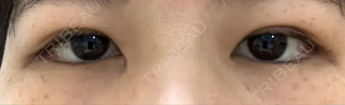 二重埋没 日本ウェルネス再生クリニック DAY 10 メイン用