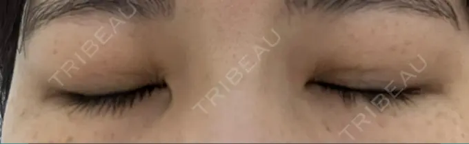 二重埋没 日本ウェルネス再生クリニック DAY 10 メイン用