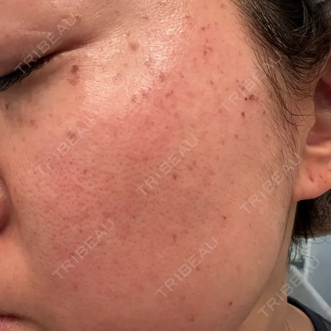 ルメッカ 東京中央クリニック AFTER メイン用