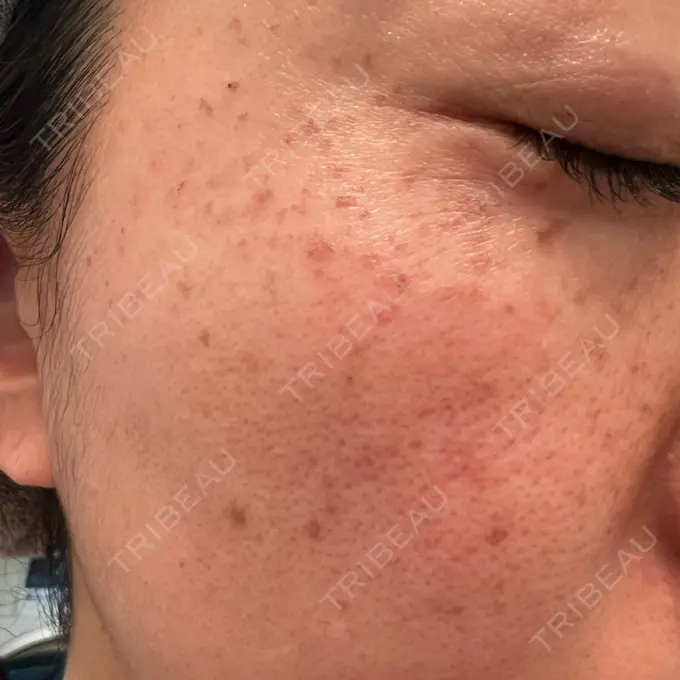 ルメッカ 東京中央クリニック DAY 0 メイン用