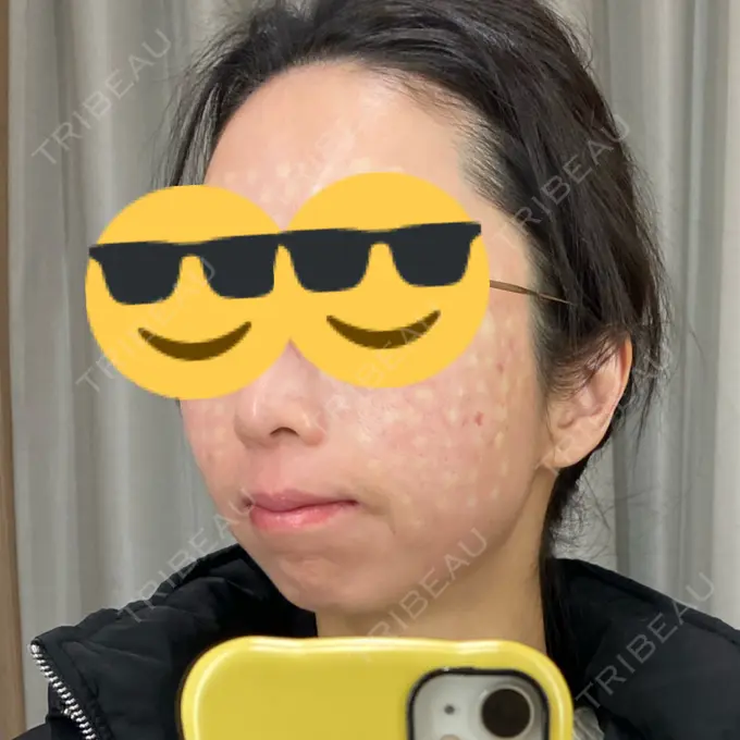 リジュラン BIANCA銀座 AFTER メイン用