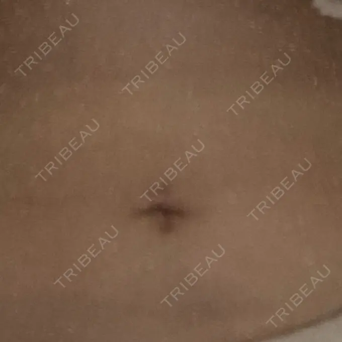 脂肪吸引（お腹） ガーデンクリニック 名古屋院 AFTER メイン用