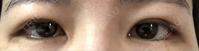 二重埋没 日本ウェルネス再生クリニック DAY 13 メイン用