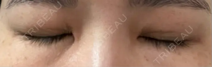 二重埋没 日本ウェルネス再生クリニック DAY 13 メイン用