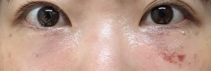 クマ治療 / 脂肪注入（目の下） アリエル美容クリニック 大宮院 DAY 10 メイン用