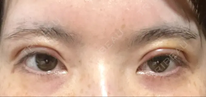 二重切開 / 上まぶたたるみ取り / 眼瞼下垂（非切開） WOM CLINIC GINZA （ワム クリニック ギンザ） DAY 6 メイン用