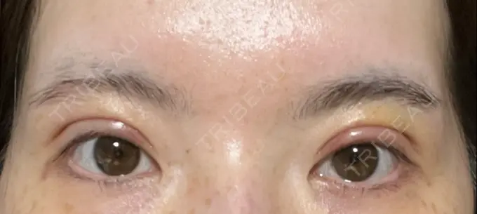 二重切開 / 上まぶたたるみ取り / 眼瞼下垂（非切開） WOM CLINIC GINZA （ワム クリニック ギンザ） DAY 7 メイン用