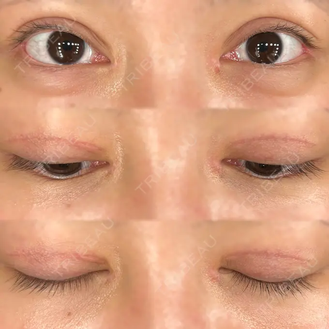 二重切開 / 目頭切開 / クマ治療 / 目尻切開 / 上まぶたたるみ取り / 下まぶたの脂肪取り / 脂肪注入（目の下） 湘南美容クリニック 大阪堺東院 DAY 62 メイン用