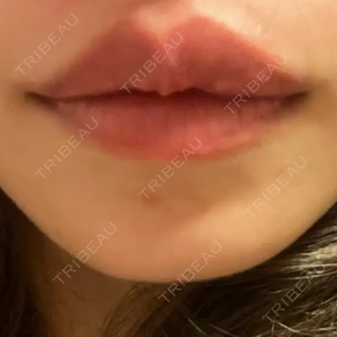 アートメイク（唇） にしまき美容スキンクリニック AFTER メイン用