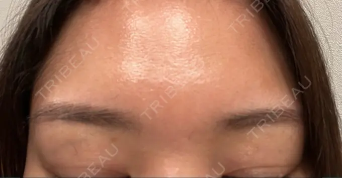 アートメイク（眉） 東京中央クリニック DAY 4 メイン用