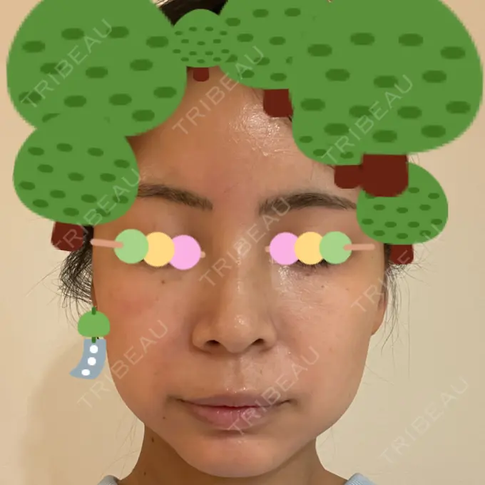 イオン導入 / ピーリング（ハリ・ツヤ） / ルメッカ ルラ美容クリニック 神戸院 AFTER メイン用