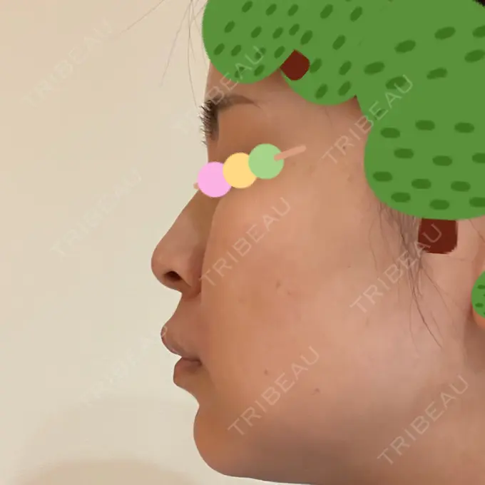 イオン導入 / ピーリング（ハリ・ツヤ） / ルメッカ ルラ美容クリニック 神戸院 DAY 3 メイン用