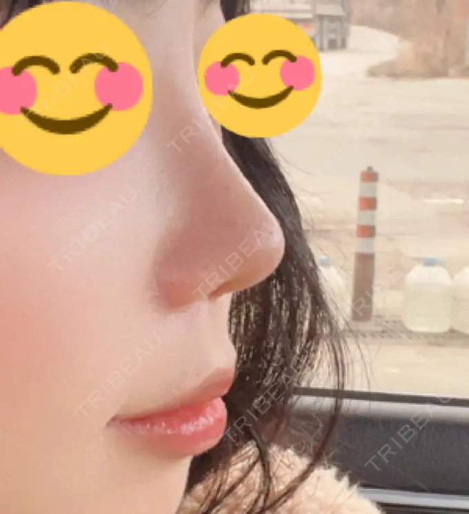 鼻尖形成（切開） / 小鼻縮小（切開） / 軟骨移植 / 鼻中隔延長（非切開） グランド整形外科 AFTER メイン用