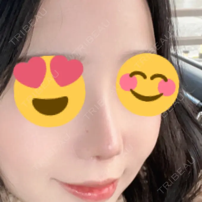 鼻尖形成（切開） / 小鼻縮小（切開） / 軟骨移植 / 鼻中隔延長（非切開） グランド整形外科 DAY 29 メイン用