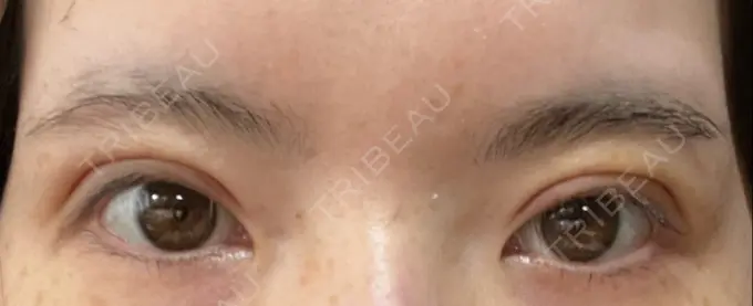 二重切開 / 上まぶたたるみ取り / 眼瞼下垂（非切開） WOM CLINIC GINZA （ワム クリニック ギンザ） DAY 8 メイン用