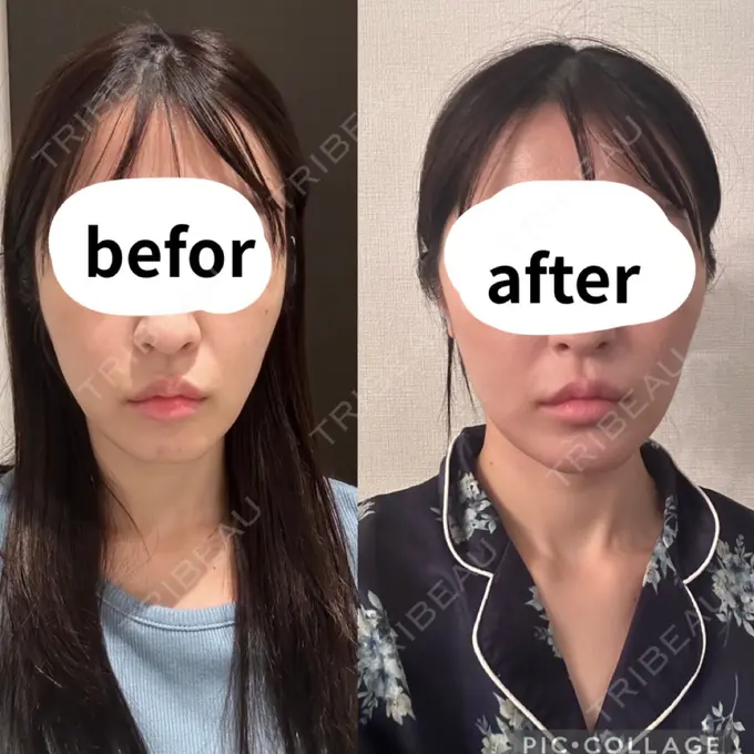 糸リフト / 脂肪吸引（顔） / ボトックス（エラ・小顔） RIVER CLINIC（リバークリニック） DAY 13 メイン用