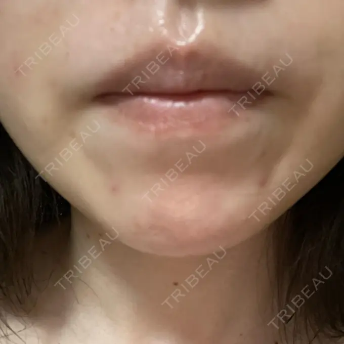 光治療（フォトフェイシャルなど） ミニマムスキンクリニック池袋 AFTER メイン用