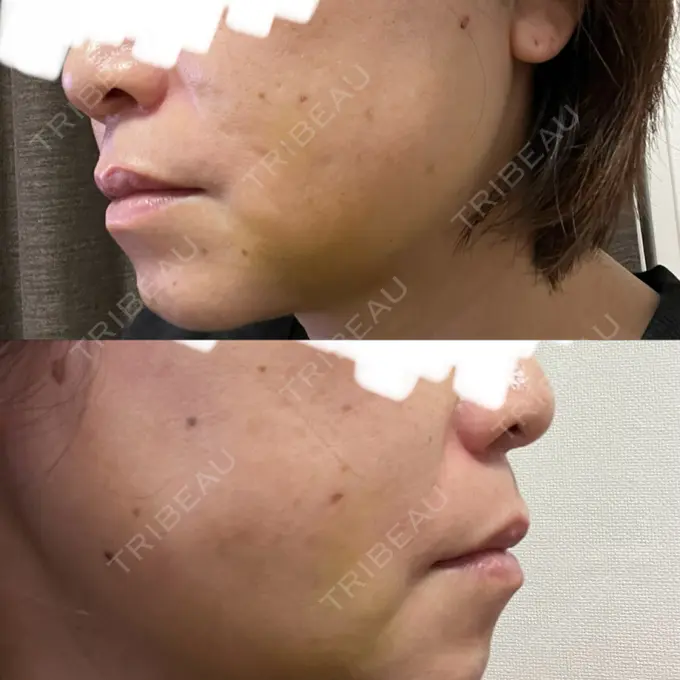 糸リフト / 脂肪吸引（顔） / 脂肪吸引注射（顔） ziz CLINIC DAY 6 メイン用