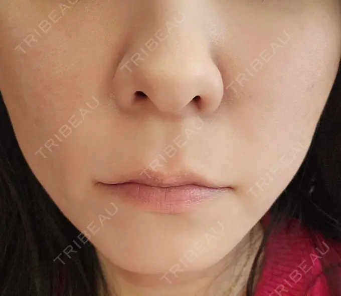 その他（肌） 湘南美容クリニック 仙台院 DAY 125 メイン用