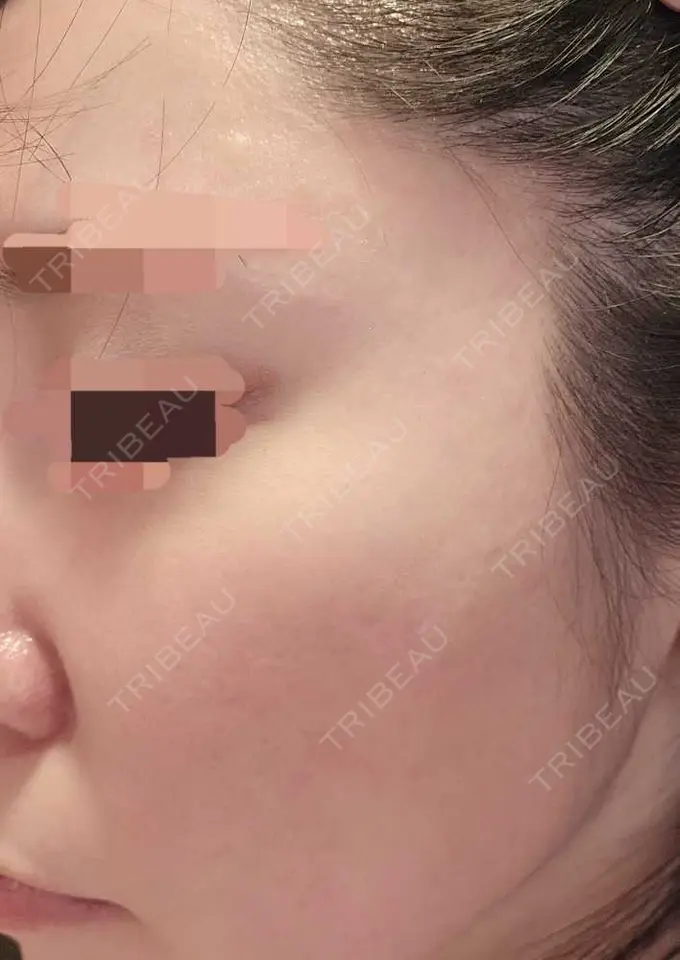 その他（肌） 湘南美容クリニック 仙台院 DAY 125 メイン用