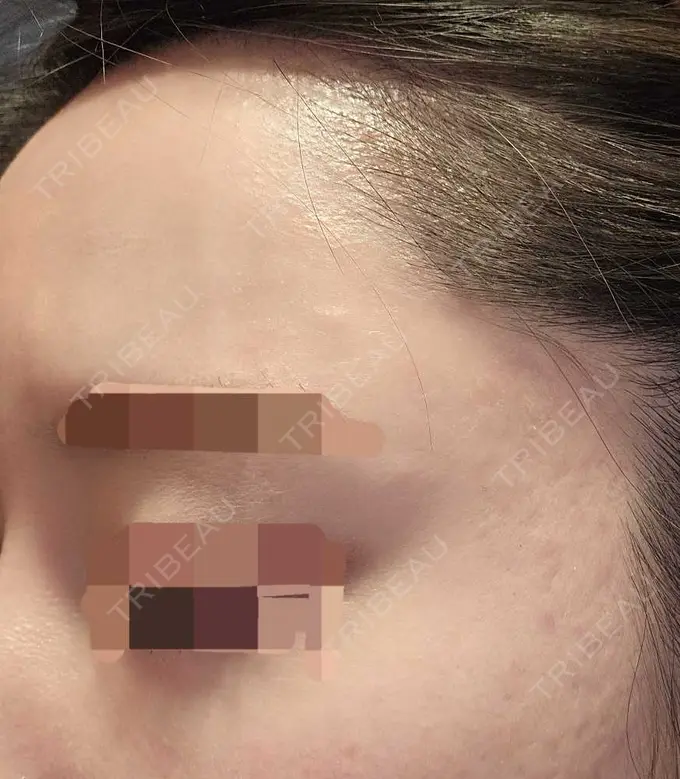 その他（肌） 湘南美容クリニック 仙台院 DAY 125 メイン用