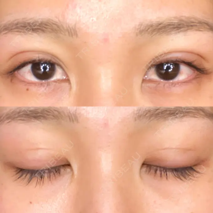 二重埋没 城本クリニック 大阪院 DAY 29 メイン用