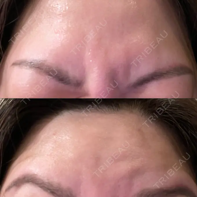 ボトックス（額） TCB東京中央美容外科 横浜駅前院 AFTER メイン用