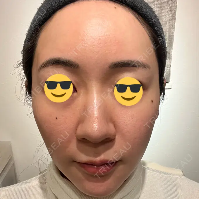 シミ取りレーザー BBC表参道院 AFTER メイン用