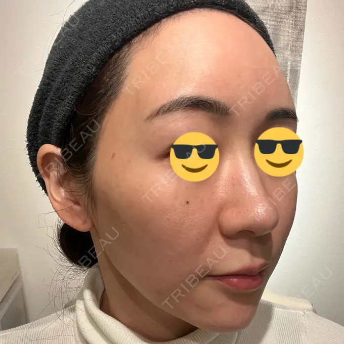 シミ取りレーザー BBC表参道院 DAY 8 メイン用