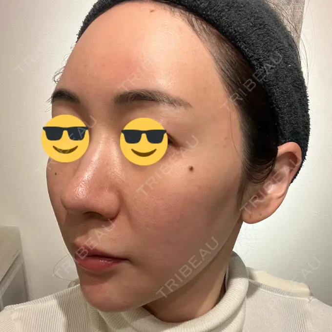 シミ取りレーザー BBC表参道院 DAY 8 メイン用