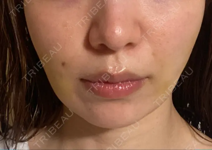 その他（肌） Rosa Beauty Clinic DAY 6 メイン用