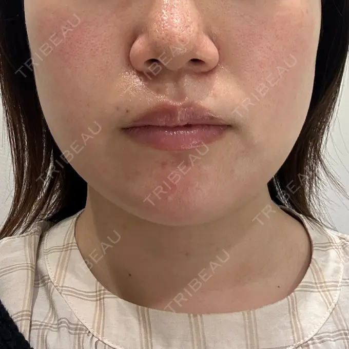 ボトックス（エラ・小顔） / ハイフ（顔） 川越TAクリニックアソシエ DAY 0 メイン用