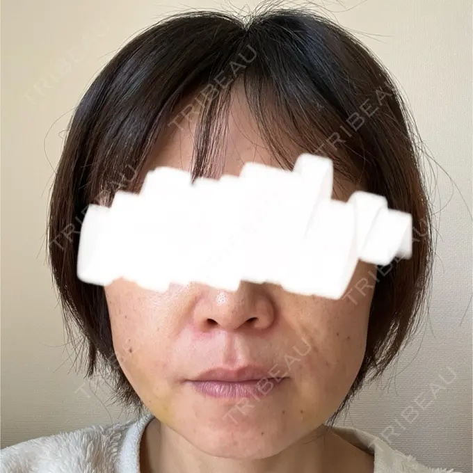 糸リフト / 脂肪吸引（顔） / 脂肪吸引注射（顔） ziz CLINIC DAY 8 メイン用