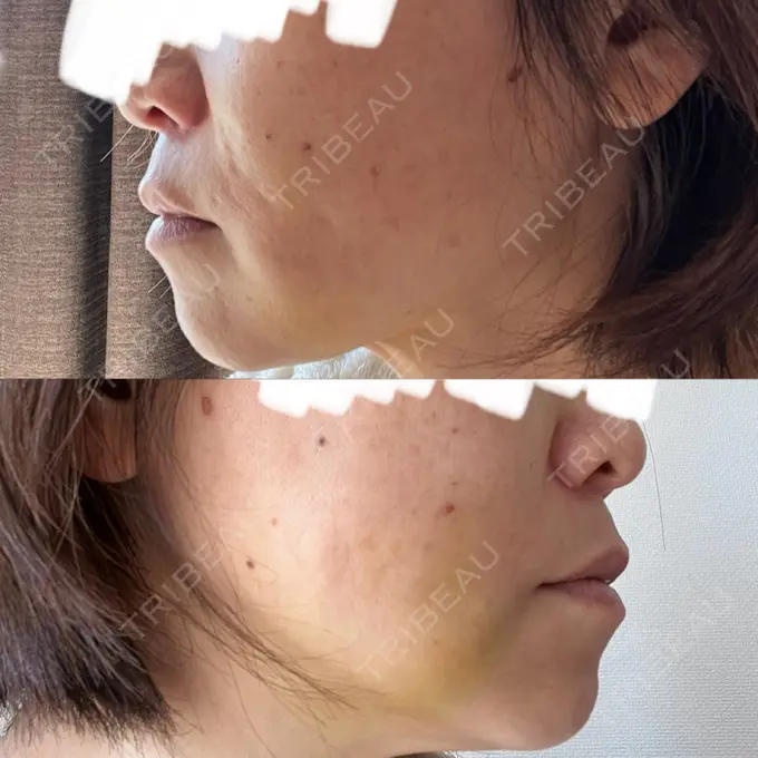 糸リフト / 脂肪吸引（顔） / 脂肪吸引注射（顔） ziz CLINIC DAY 8 メイン用