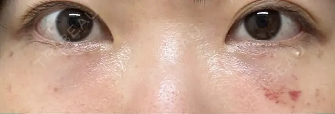 クマ治療 / 脂肪注入（目の下） アリエル美容クリニック 大宮院 DAY 11 メイン用