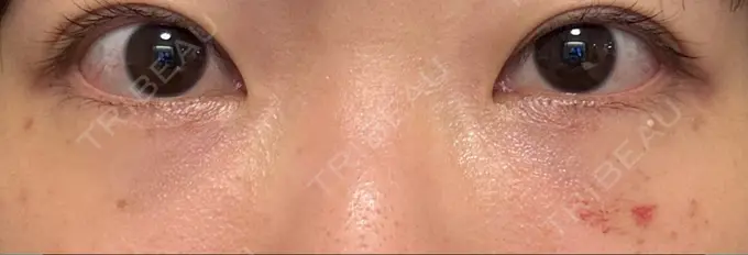 クマ治療 / 脂肪注入（目の下） アリエル美容クリニック 大宮院 DAY 12 メイン用