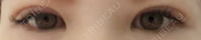 二重埋没 OMI CLINIC 【オミクリニック】 DAY 4 メイン用