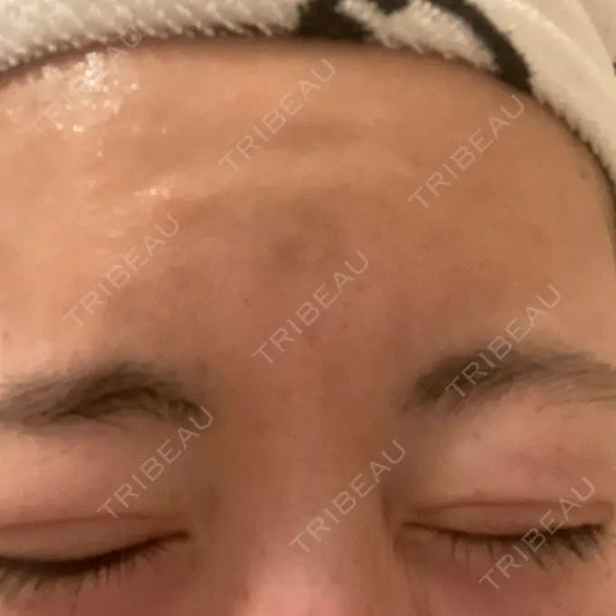 ボトックス（眉間） 湘南美容クリニック 金山院 AFTER メイン用