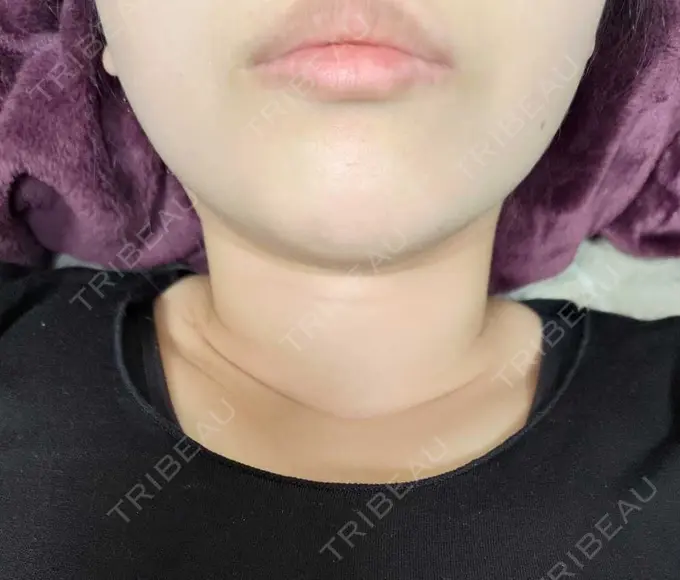 脂肪溶解注射（顔） 表参道ウィズ・クリニック AFTER メイン用