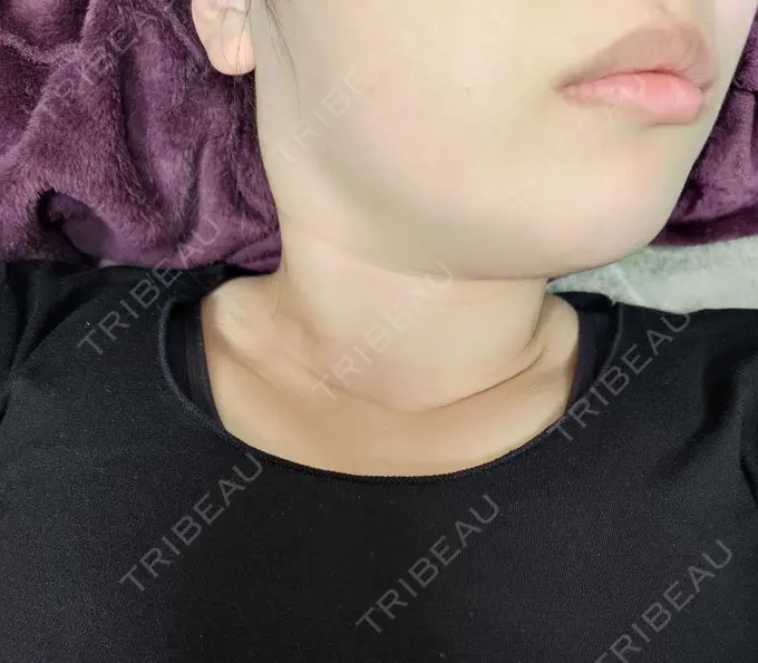 脂肪溶解注射（顔） 表参道ウィズ・クリニック DAY 7 メイン用