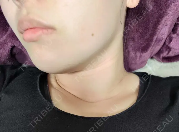 脂肪溶解注射（顔） 表参道ウィズ・クリニック DAY 7 メイン用