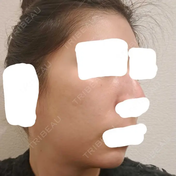 ヴェルヴェットスキン ブリリアスキンクリニック DAY 3 メイン用