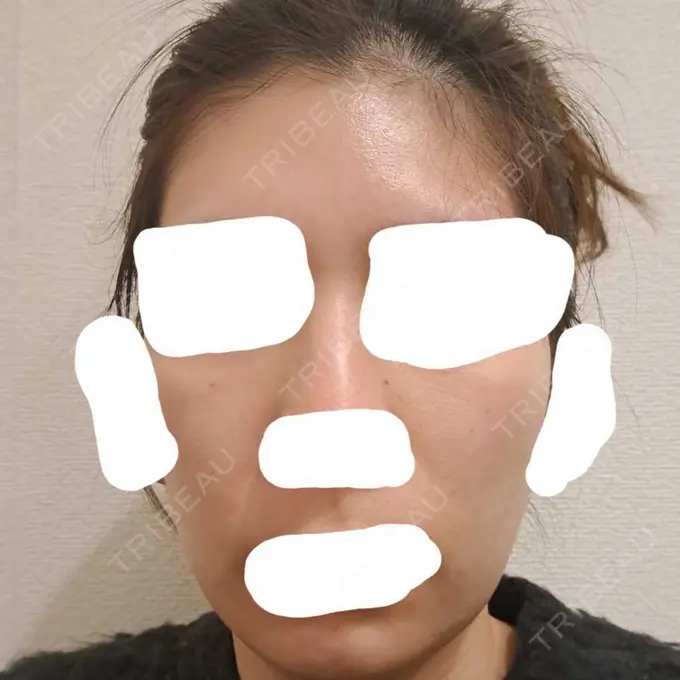 ヴェルヴェットスキン ブリリアスキンクリニック DAY 3 メイン用