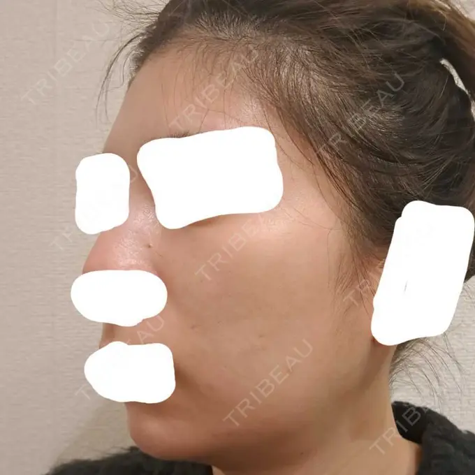 ヴェルヴェットスキン ブリリアスキンクリニック DAY 3 メイン用