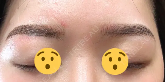 アートメイク（眉） MYCLINIC 西新宿 DAY 1 メイン用