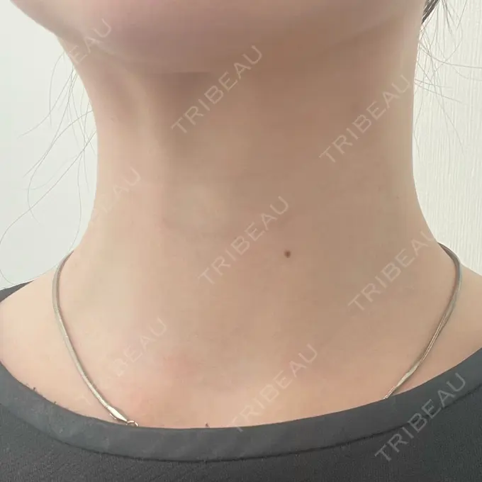 ガミースマイル手術 / ボトックス（エラ・小顔） / ボトックス（首） 東京シンデレラ美容外科 大宮院 DAY 0 メイン用