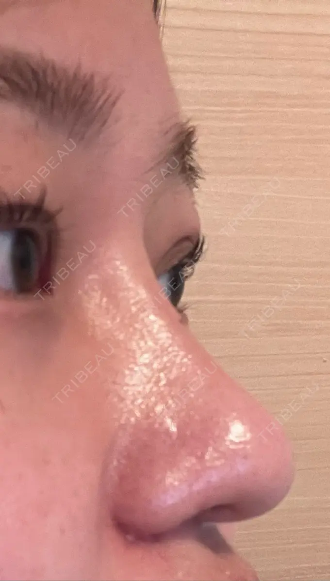 隆鼻術 / 鼻尖形成（切開） / 小鼻縮小（切開） / 軟骨移植 グローバルビューティークリニック 銀座院 AFTER メイン用