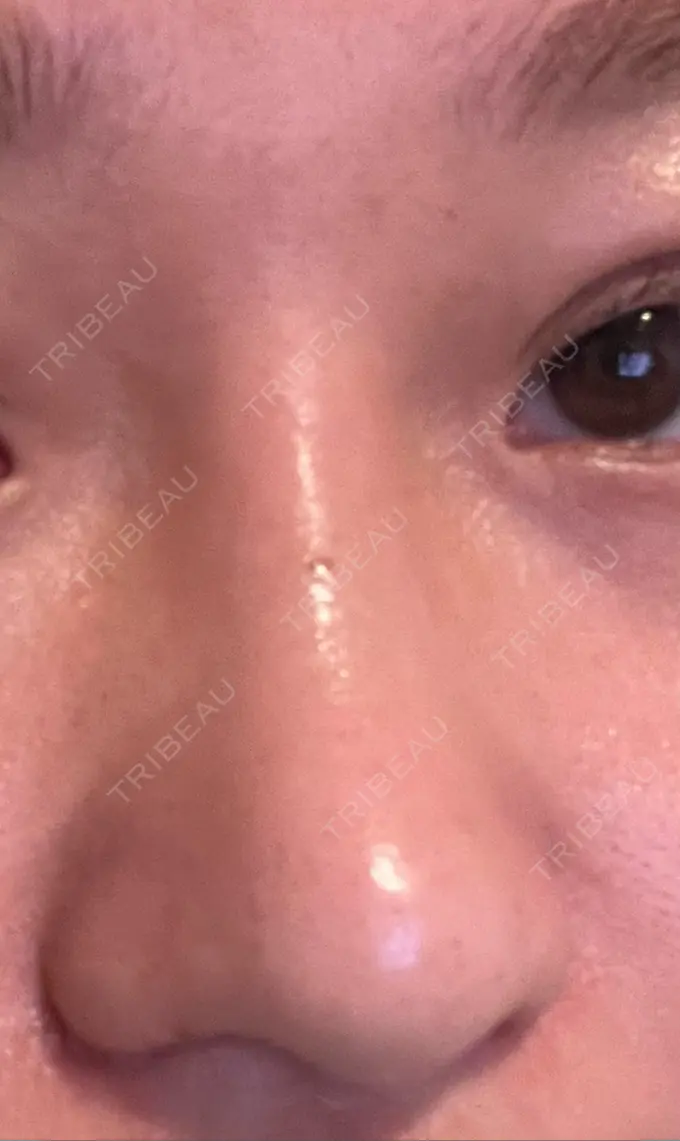 隆鼻術 / 鼻尖形成（切開） / 小鼻縮小（切開） / 軟骨移植 グローバルビューティークリニック 銀座院 DAY 33 メイン用