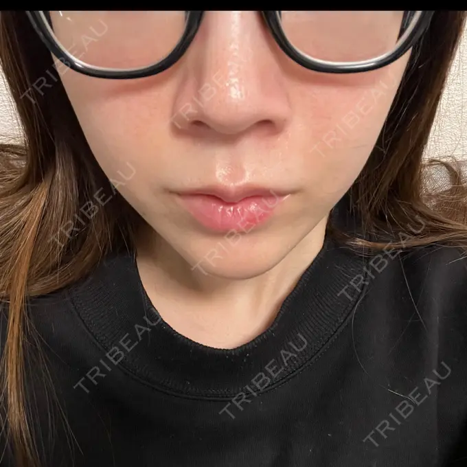 ダーマペン / ヴェルヴェットスキン 表参道メディカルクリニック 福岡天神院 AFTER メイン用