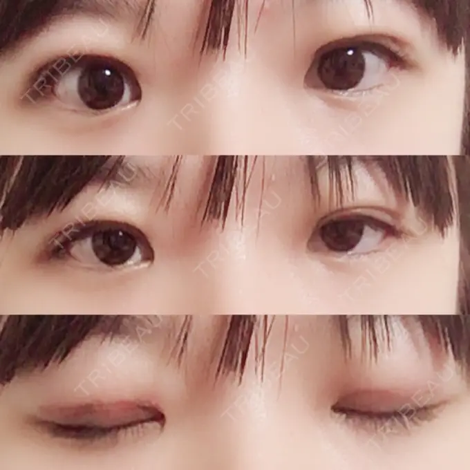 二重切開 / 上まぶたの脂肪取り 聖心美容クリニック 横浜院 DAY 18 メイン用